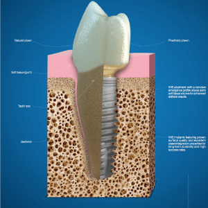 Dental implant diagram