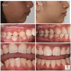 orthodontic before and after 