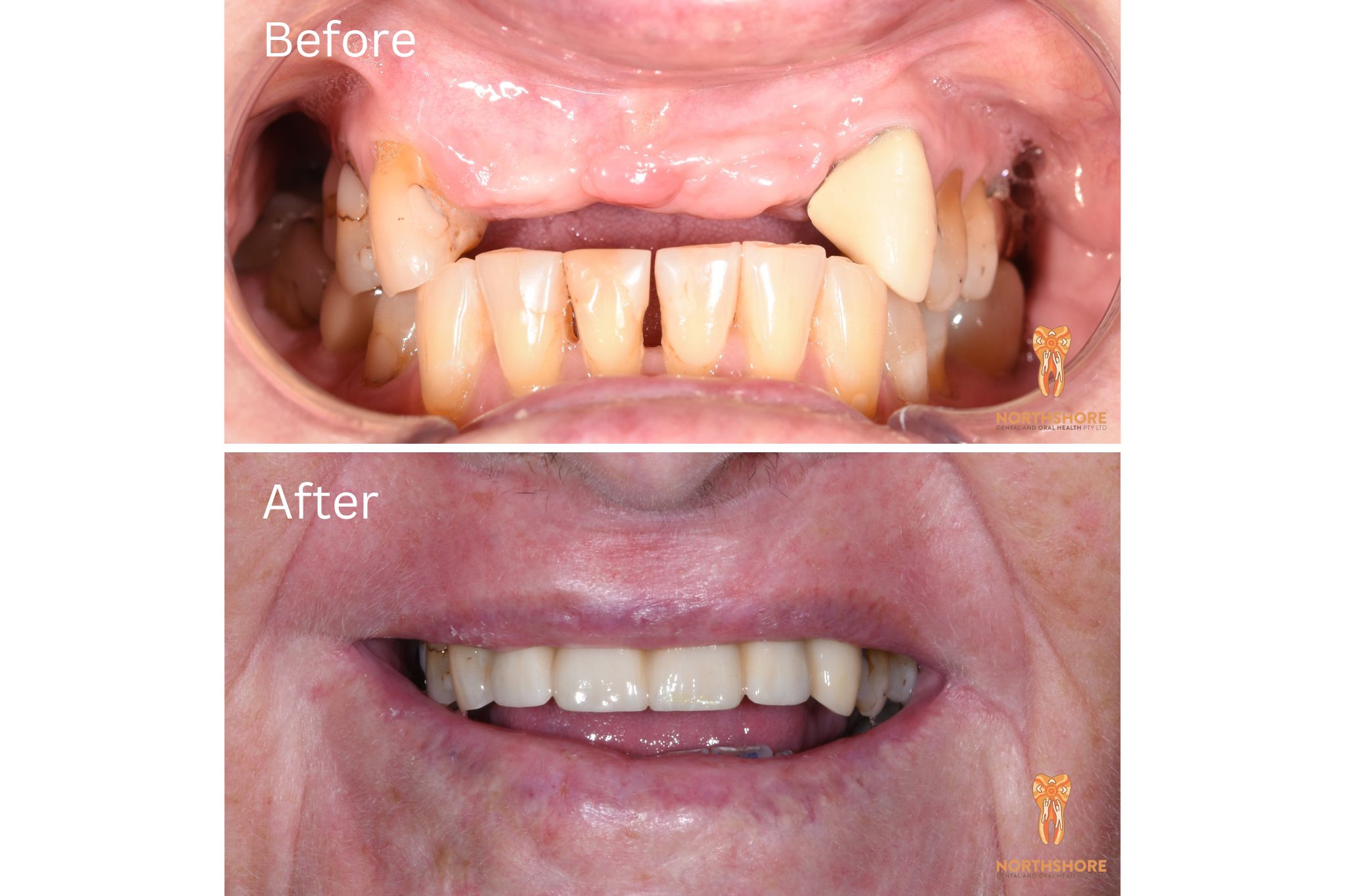 Can I use my superannuation for Dental Treatment?